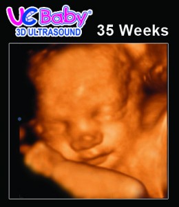 UC Baby 3D Ultrasound 35 Weeks