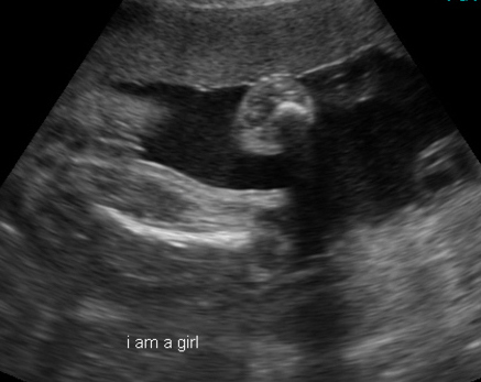 When can ultrasound detect gender