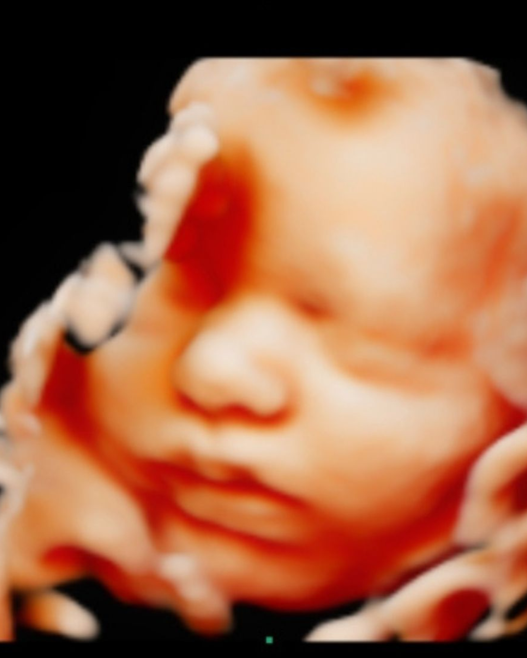 Gender Reveal Blood Test