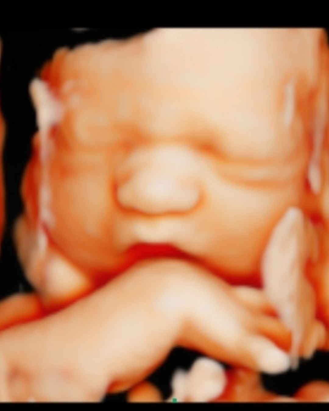 Gender Reveal Blood Test