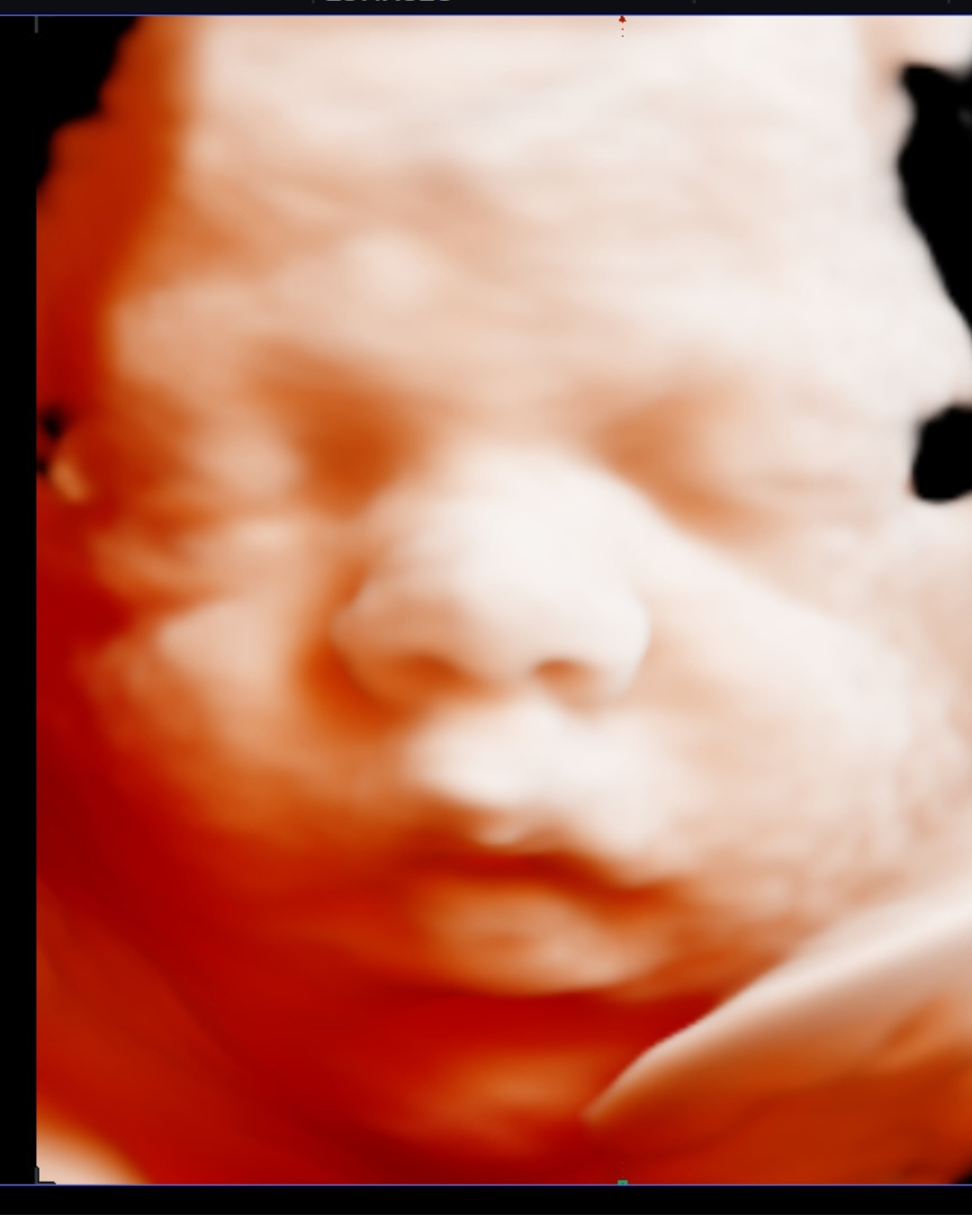 Gender Reveal Blood Test