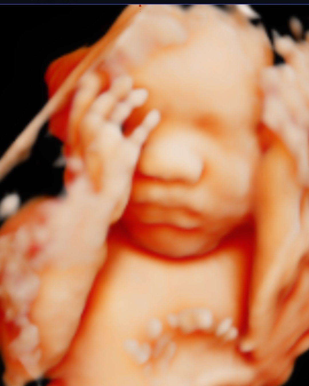 Gender Reveal Blood Test