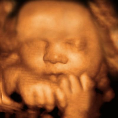 UC Baby 3D Ultrasound photo 12