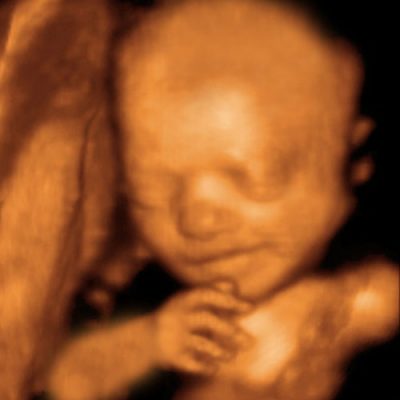 UC Baby 3D Ultrasound Image