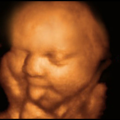 UC Baby 3D Ultrasound photo 11