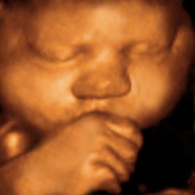 UC Baby 3D Ultrasound photo 7