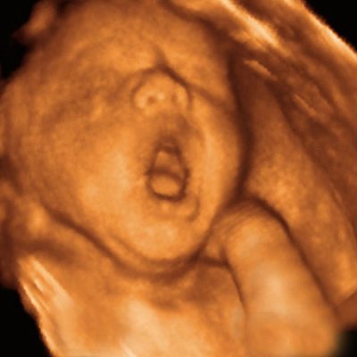 UC Baby 3D Ultrasound photo 4