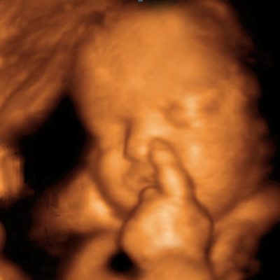 UC Baby 3D Ultrasound photo gallery 11