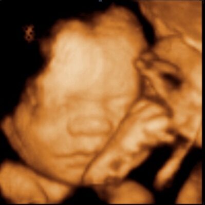 UC Baby 3D Ultrasound Image - feet