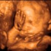 UC Baby 3D Ultrasound Image - rubbing eye