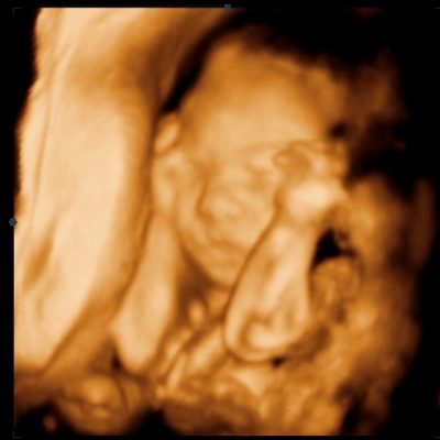 UC Baby 3D Ultrasound Image - arms on face