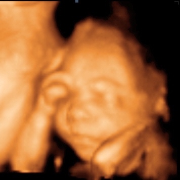 UC Baby 3D Ultrasound Image - hand on eye