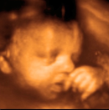 UC Baby 3D Ultrasound Image - mouth open