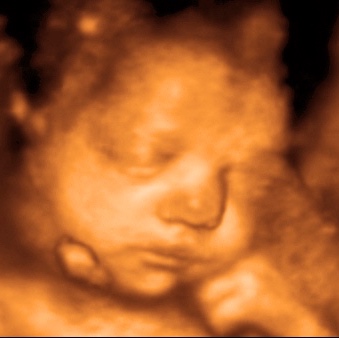 UC Baby 3D Ultrasound Image - face resting on hand