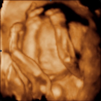 UC Baby 3D Ultrasound Image - arms up