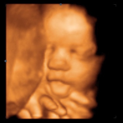 UC Baby 3D Ultrasound Image - tongue sticking out