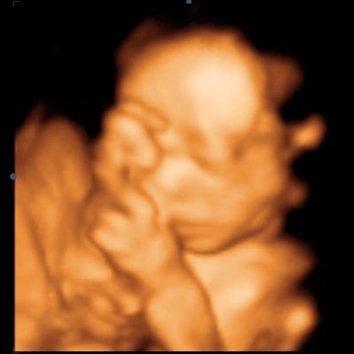 UC Baby 3D Ultrasound Image - hand cover eye