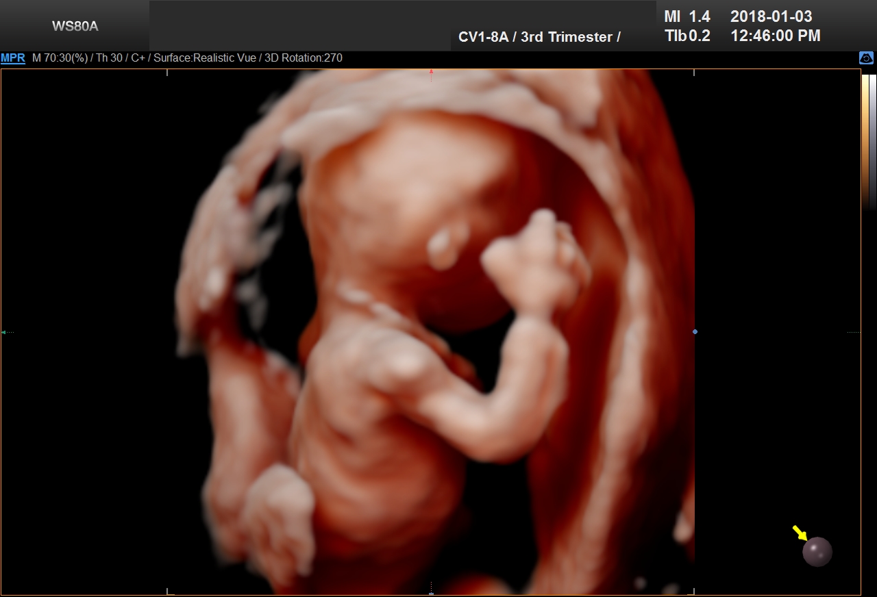 UC Baby 3D Ultrasound Image