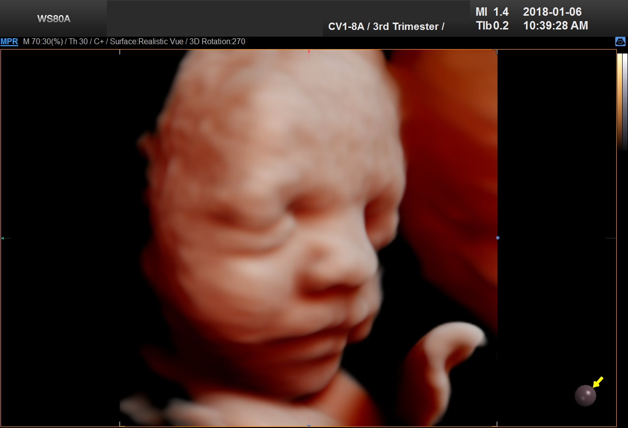 UC Baby 3D Ultrasound Image