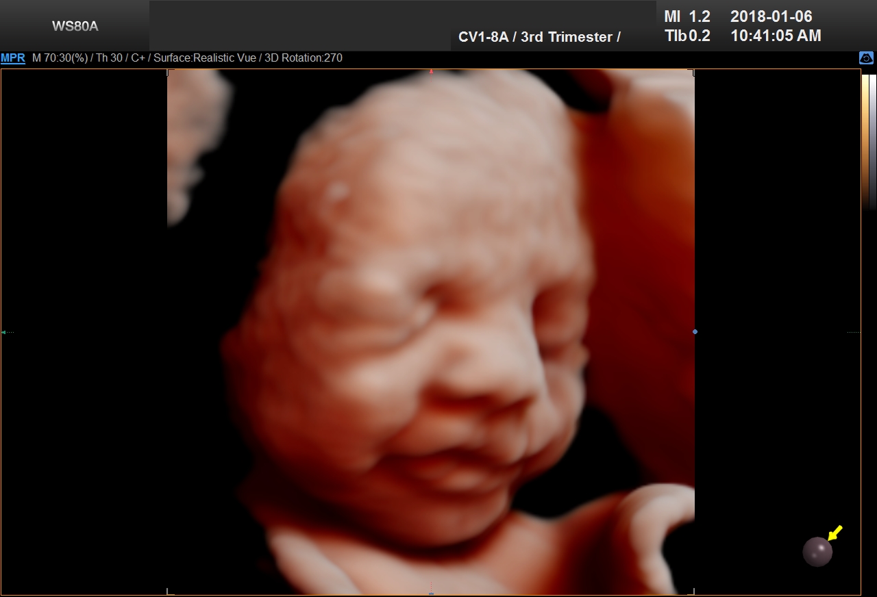 UC Baby 3D Ultrasound Image