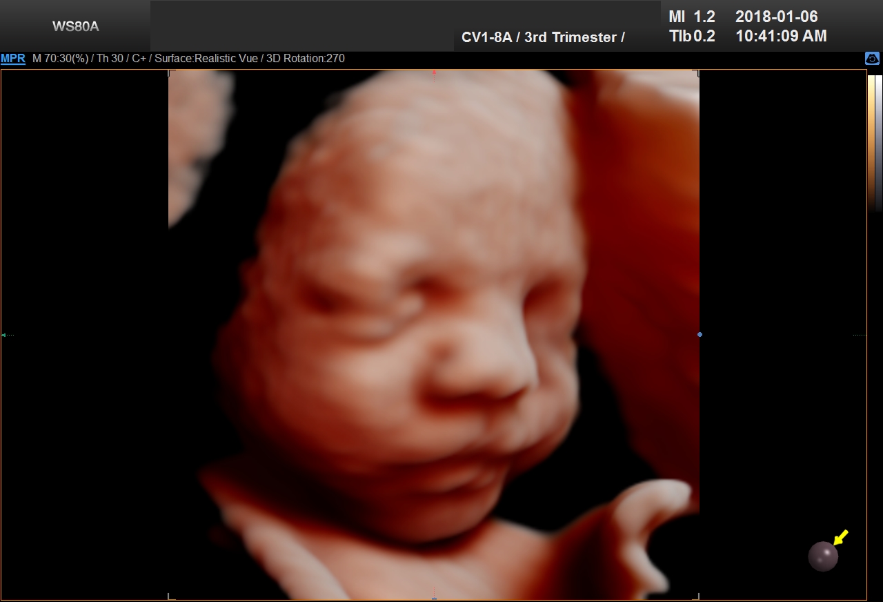 UC BABY 3D 4D 5D ultrasound