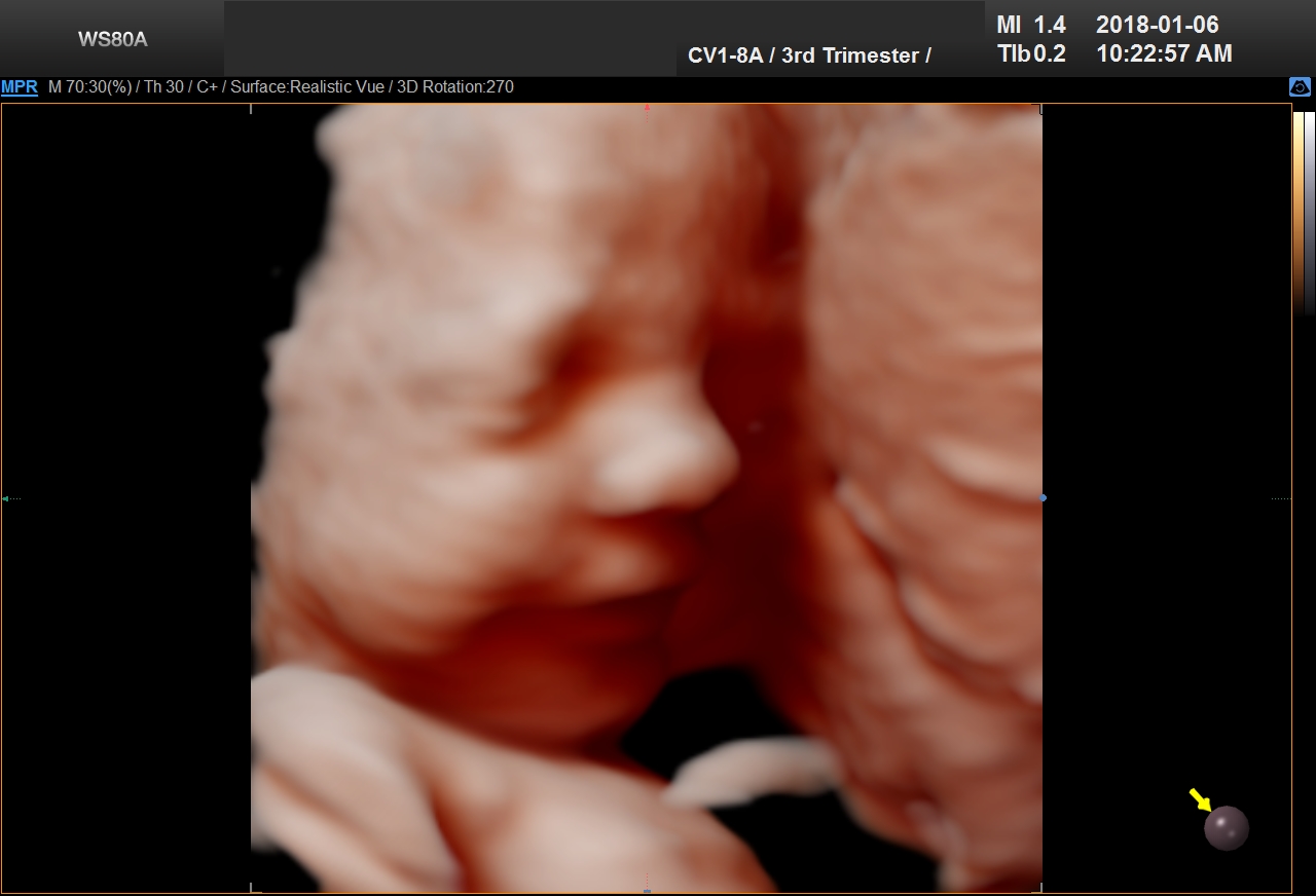 UC BABY 3D 4D 5D ultrasound